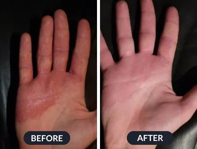 Swissclear™ Eczema Relief