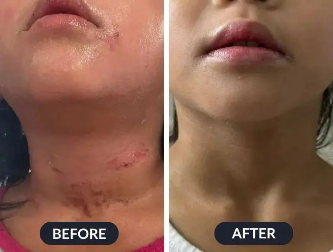 Swissclear™ Eczema Relief