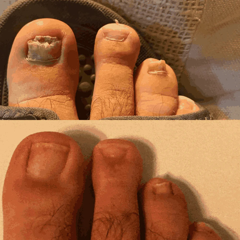 Swissclear™ LLLT Device + Free Fungal Patches