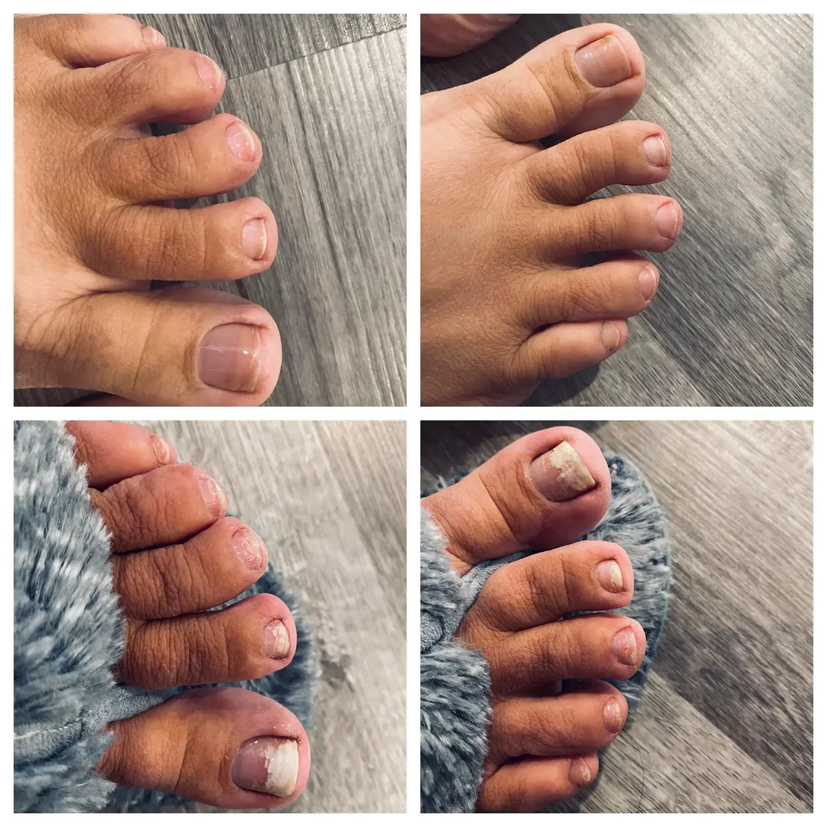 Swissclear™ Therapy Device : Your path to Fungus-Free Nails