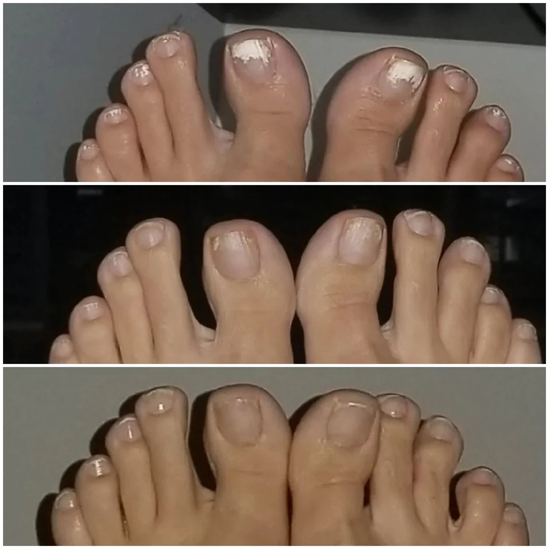 Swissclear™ Therapy Device : Your path to Fungus-Free Nails